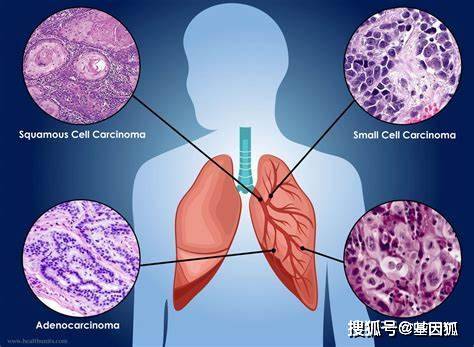 肺腺癌转移速度概览表